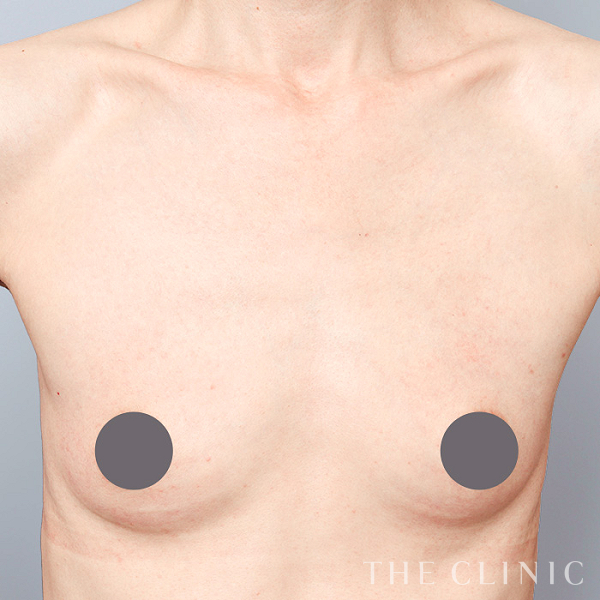 ボリュームアップのコンデンスビブラ豊胸（51歳女性）の術前写真