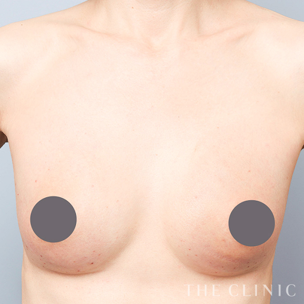 ボリュームアップのコンデンスビブラ豊胸（51歳女性）の術後写真