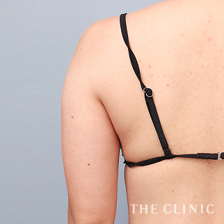 【THE CLINIC 症例画像】No.1598_1_二の腕_360脂肪吸引®