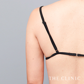 【THE CLINIC 症例画像】No.1598_2_二の腕_360脂肪吸引®