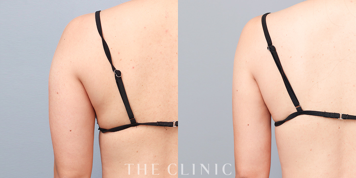 ベイザー脂肪吸引の術前／術後