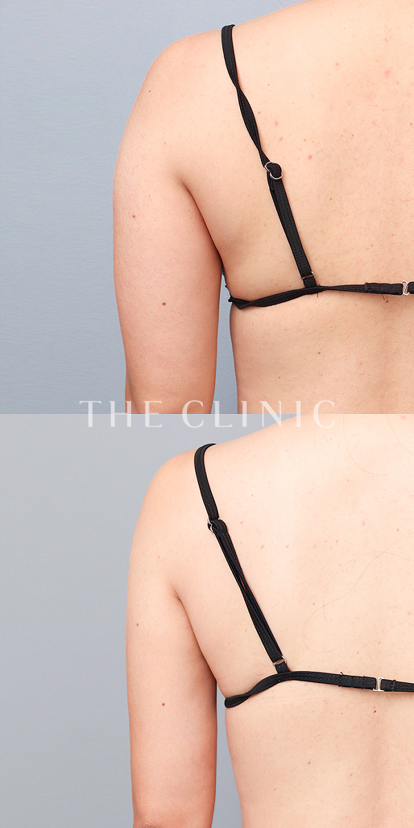 二の腕のベイザー脂肪吸引（35歳女性）の術前・術後写真