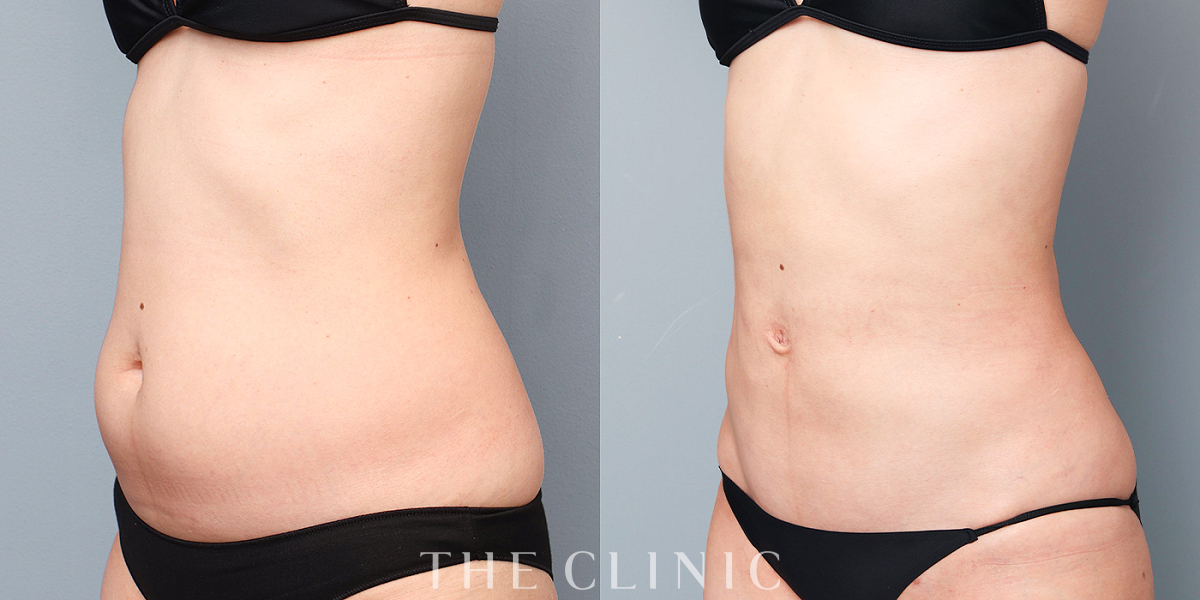 ベイザー脂肪吸引の術前／術後