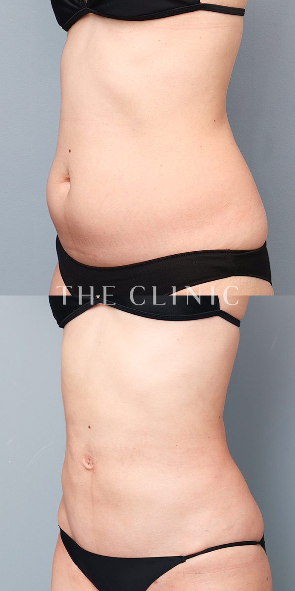 腹部のベイザー脂肪吸引（35歳女性）の術前・術後写真