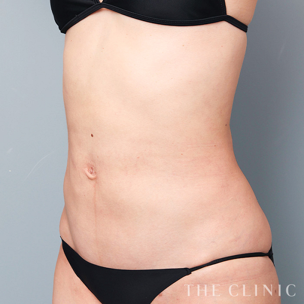 腹部のベイザー脂肪吸引（35歳女性）の術後写真