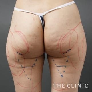 【THE CLINIC 症例画像】No.15_1_お尻_360脂肪吸引®