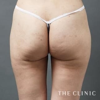 【THE CLINIC 症例画像】No.15_2_お尻_360脂肪吸引®