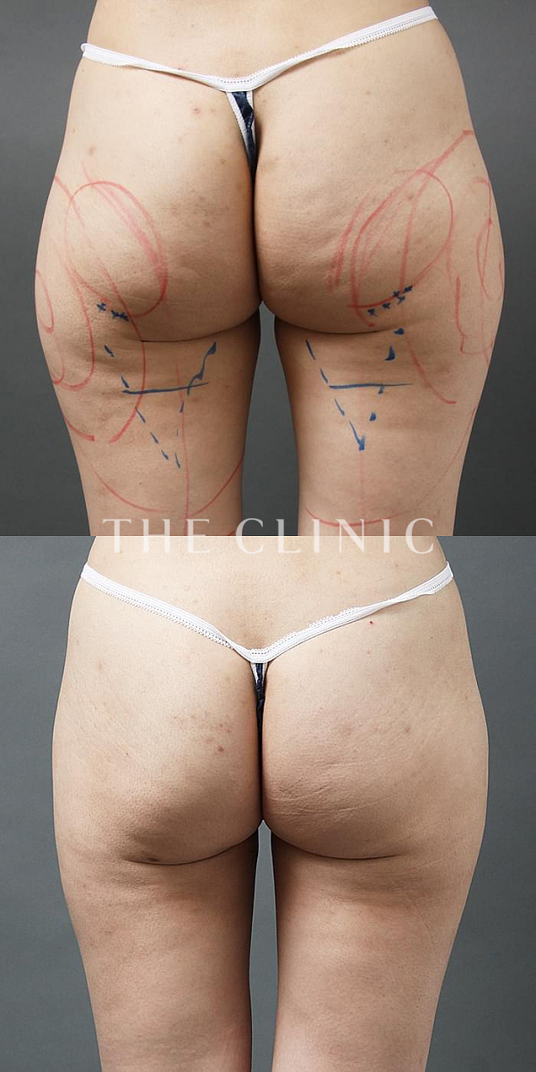 お尻のベイザー脂肪吸引（35歳女性）の術前・術後写真