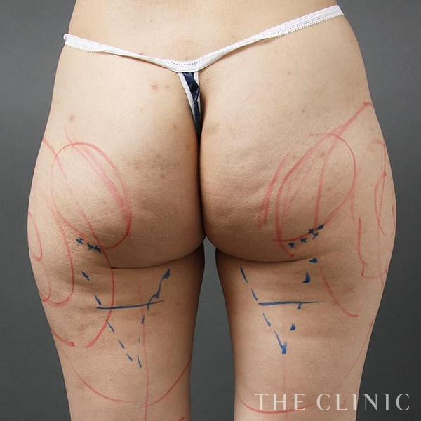 お尻のベイザー脂肪吸引（35歳女性）の術前写真
