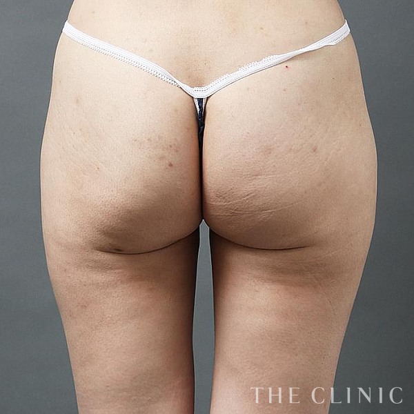 お尻のベイザー脂肪吸引（35歳女性）の術後写真