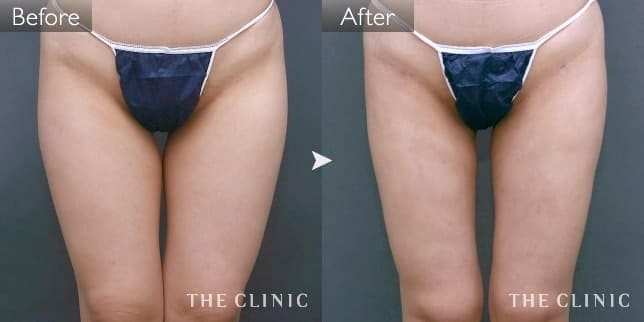 太もも(女性/41歳)