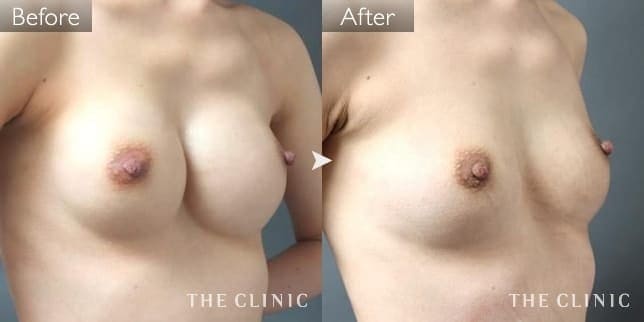 シリコンバッグ抜去（女性／31歳）