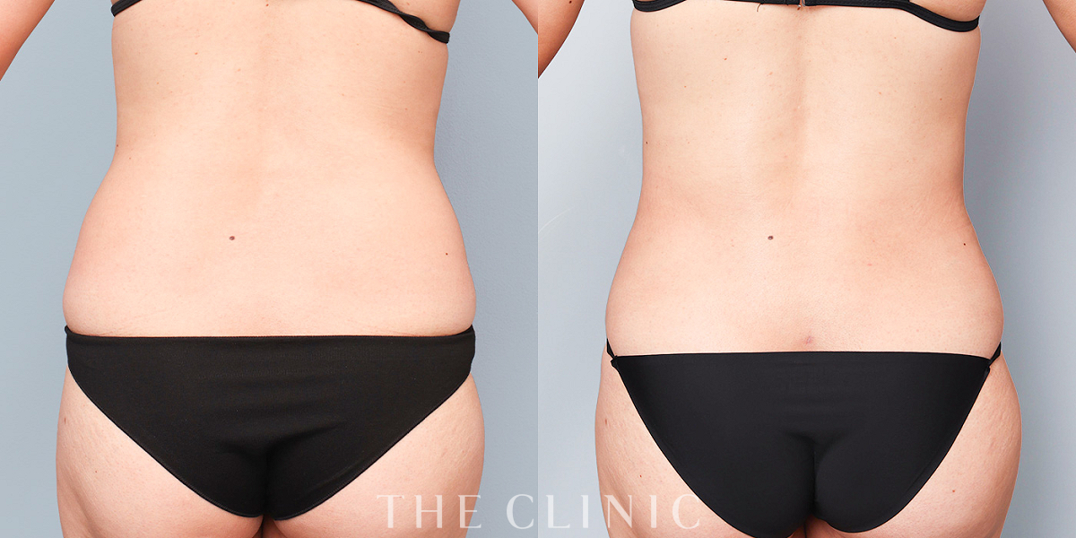 ベイザー脂肪吸引の術前／術後