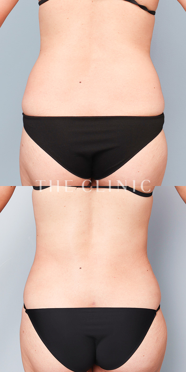 腰・ウエストのベイザー脂肪吸引（35歳女性）の術前・術後写真