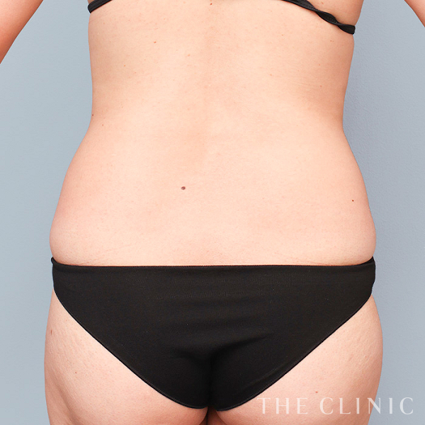 腰・ウエストのベイザー脂肪吸引（35歳女性）の術前写真