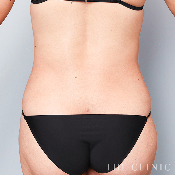 腰・ウエストのベイザー脂肪吸引（35歳女性）の術後写真