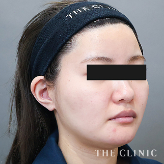 【THE CLINIC 症例画像】No.1601_1_頰/顎_360脂肪吸引®