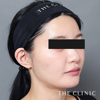 【THE CLINIC 症例画像】No.1601_2_頰/顎_360脂肪吸引®