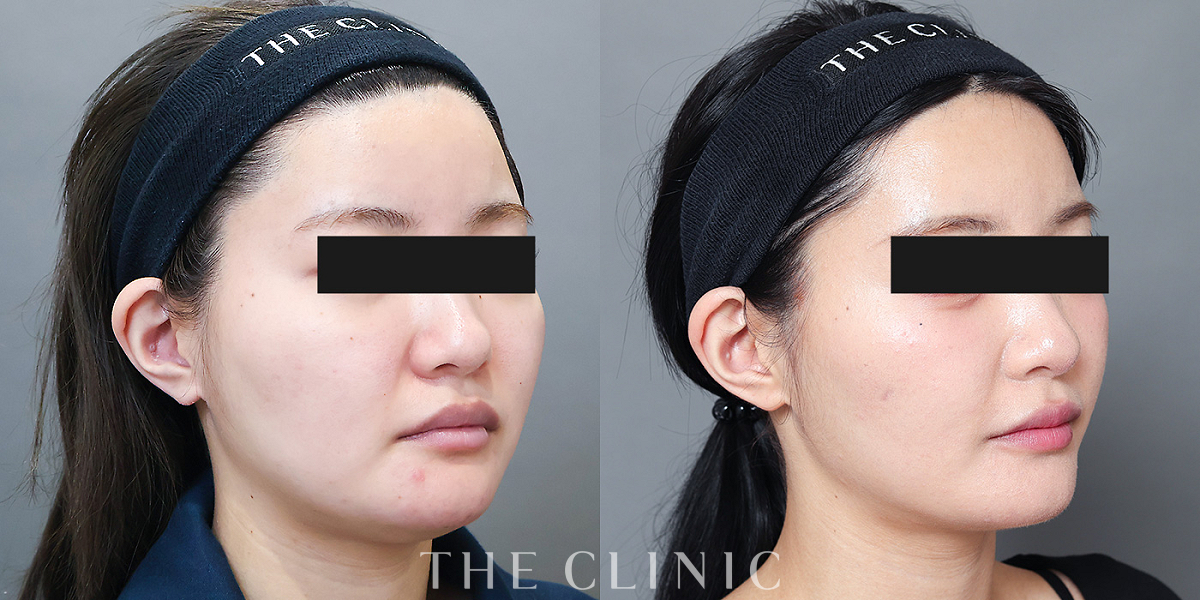 頰／顎のベイザー脂肪吸引（22歳女性）の術前／術後