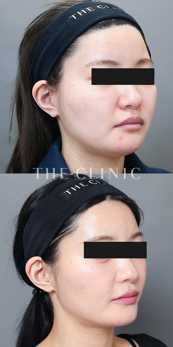 頰／顎のベイザー脂肪吸引（22歳女性）の術前・術後写真