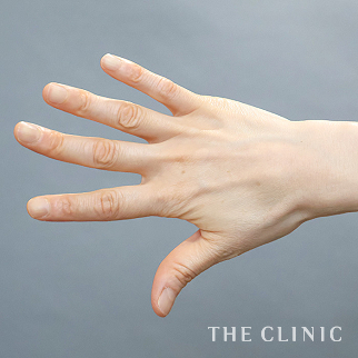 【THE CLINIC 症例画像】No.1602_1_手のシワ_手の甲への脂肪注入(ハンドリバイブ)