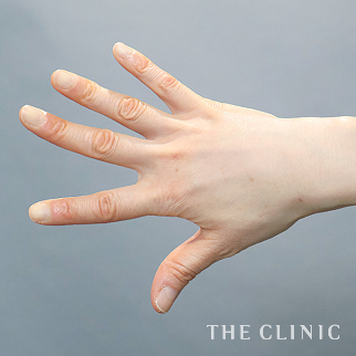 【THE CLINIC 症例画像】No.1602_2_手のシワ_手の甲への脂肪注入(ハンドリバイブ)