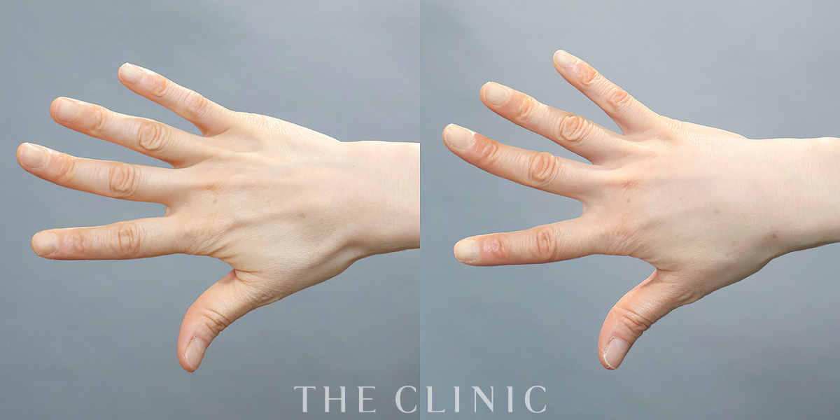 手の甲への脂肪注入(ハンドリバイブ)の術前/術後