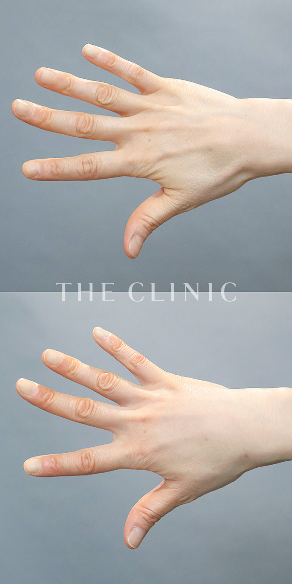 手のシワの手の甲への脂肪注入(ハンドリバイブ)（52歳女性）の術前・術後写真