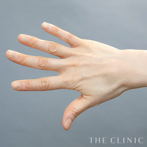 手のシワの手の甲への脂肪注入(ハンドリバイブ)（52歳女性）の術前写真