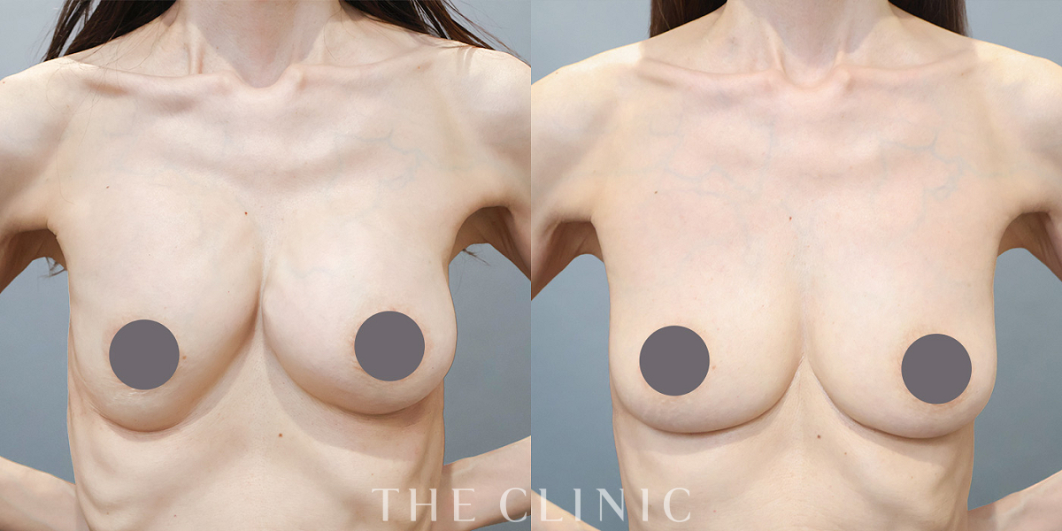 豊胸シリコンバッグ除去の術前／術後