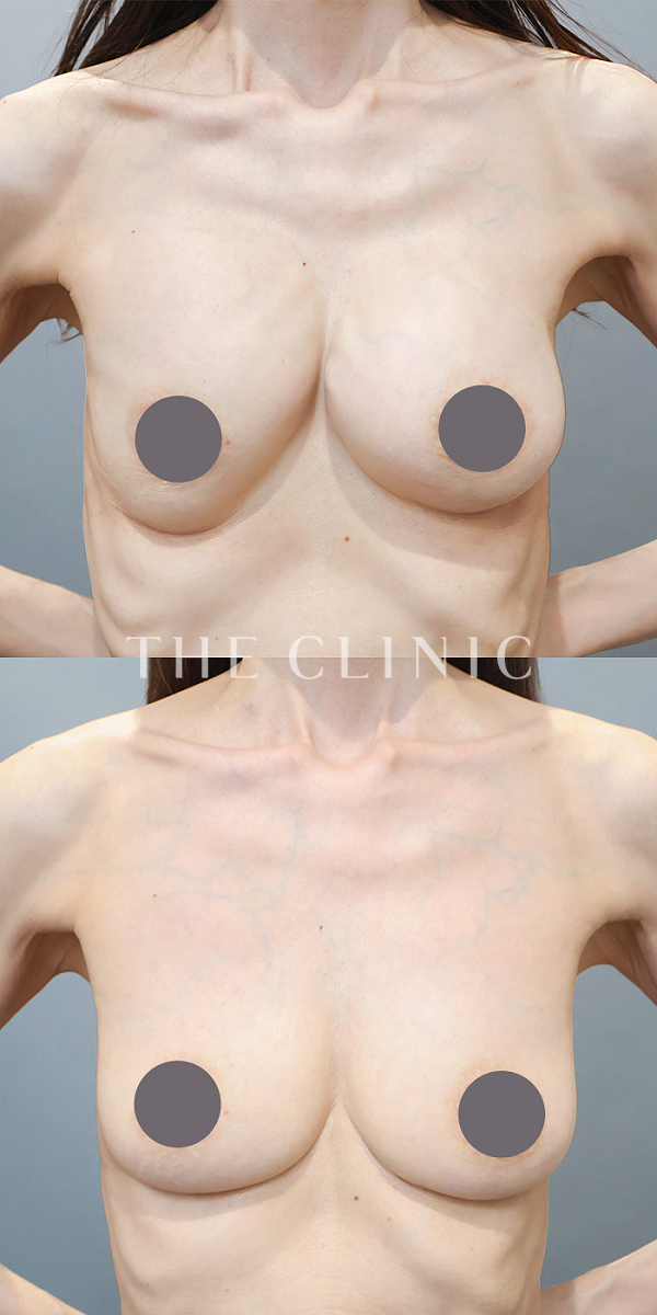 シリコンバッグ抜去の豊胸シリコンバッグ除去（54歳女性）の術前・術後写真