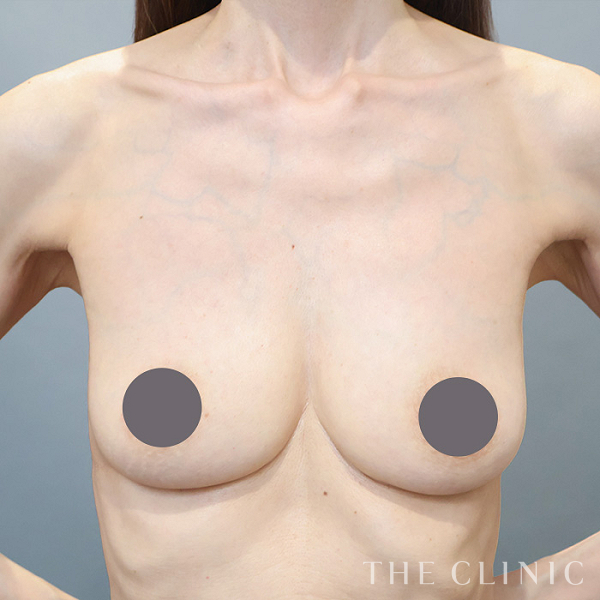 シリコンバッグ抜去の豊胸シリコンバッグ除去（54歳女性）の術後写真