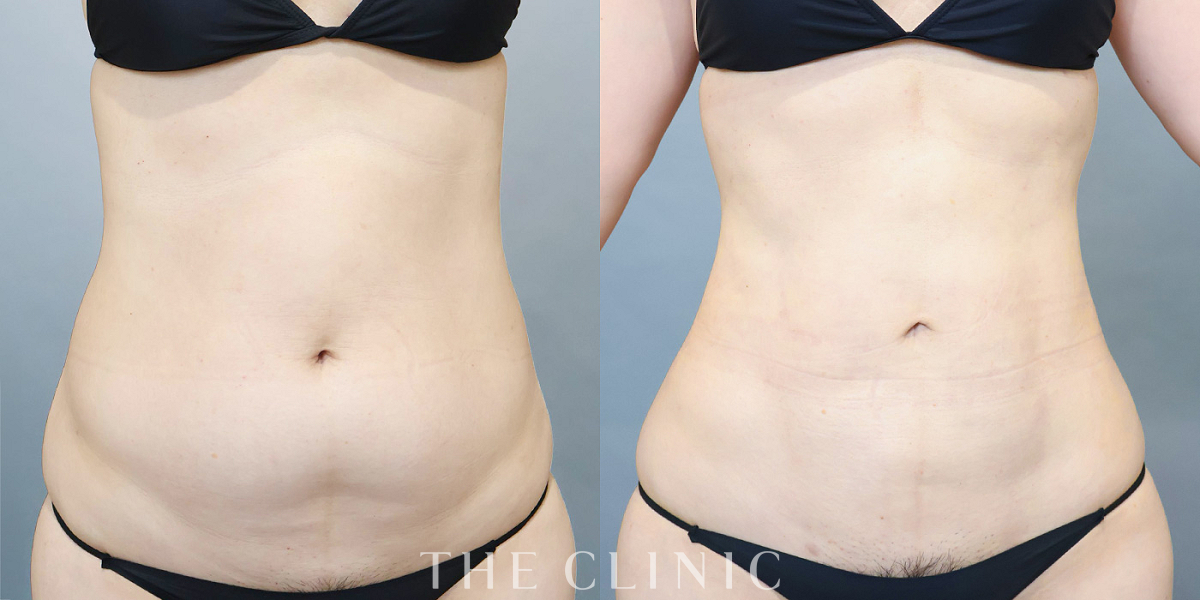 ベイザー脂肪吸引の術前／術後