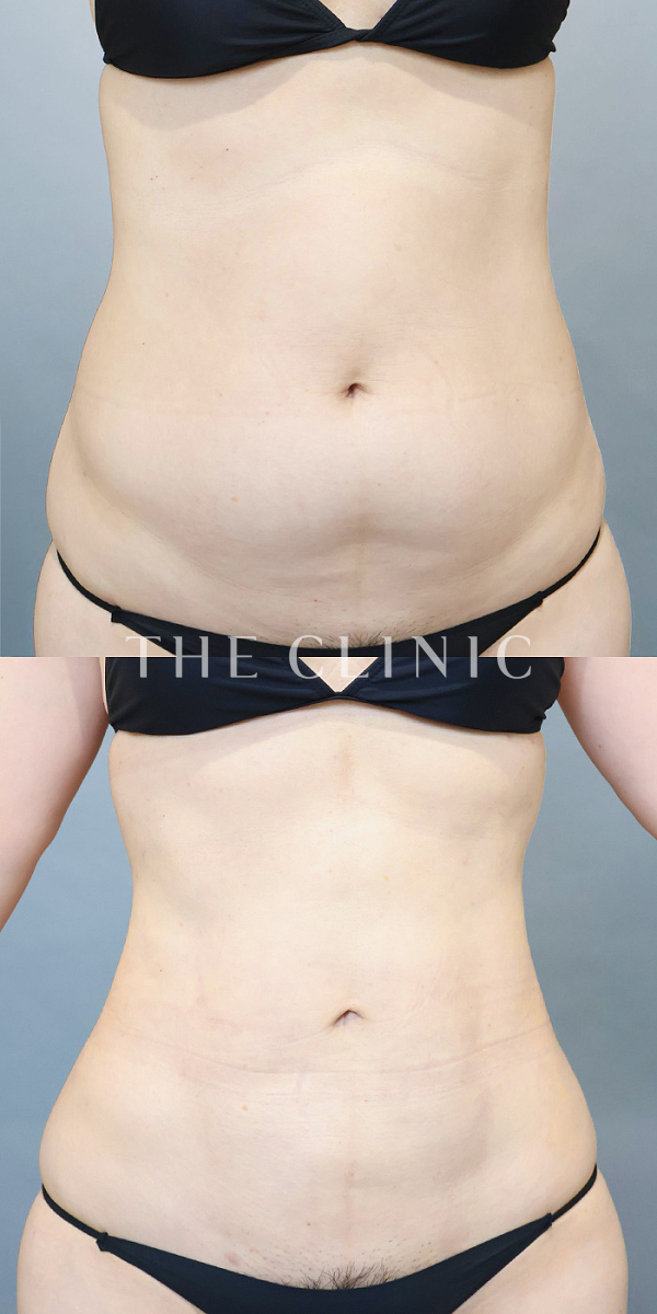 腹部のベイザー脂肪吸引（37歳女性）の術前・術後写真