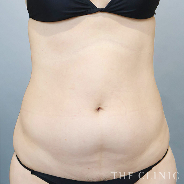 腹部のベイザー脂肪吸引（37歳女性）の術前写真