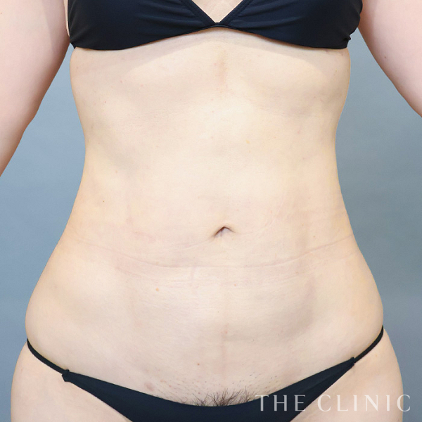 腹部のベイザー脂肪吸引（37歳女性）の術後写真
