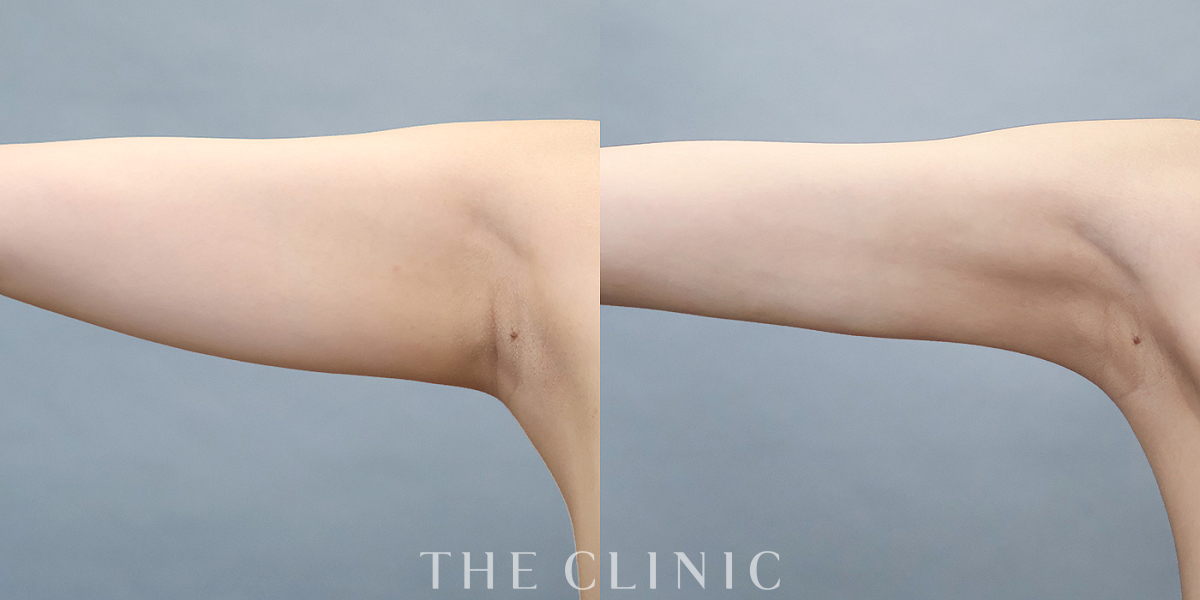 ベイザー脂肪吸引の術前／術後