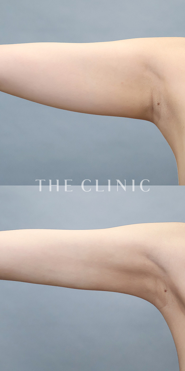 二の腕のベイザー脂肪吸引（20歳女性）の術前・術後写真