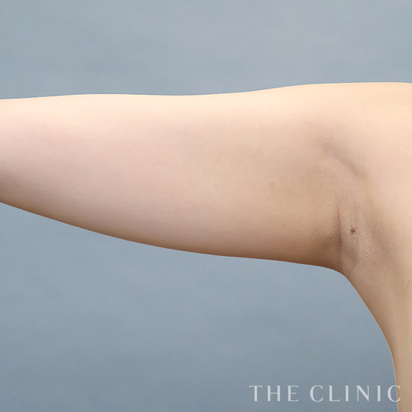 二の腕のベイザー脂肪吸引（20歳女性）の術前写真