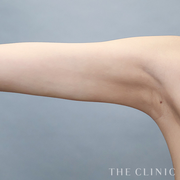 二の腕のベイザー脂肪吸引（20歳女性）の術後写真