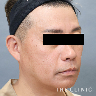 【THE CLINIC 症例画像】No.1606_1_頰/顎_360脂肪吸引®(執刀医:)