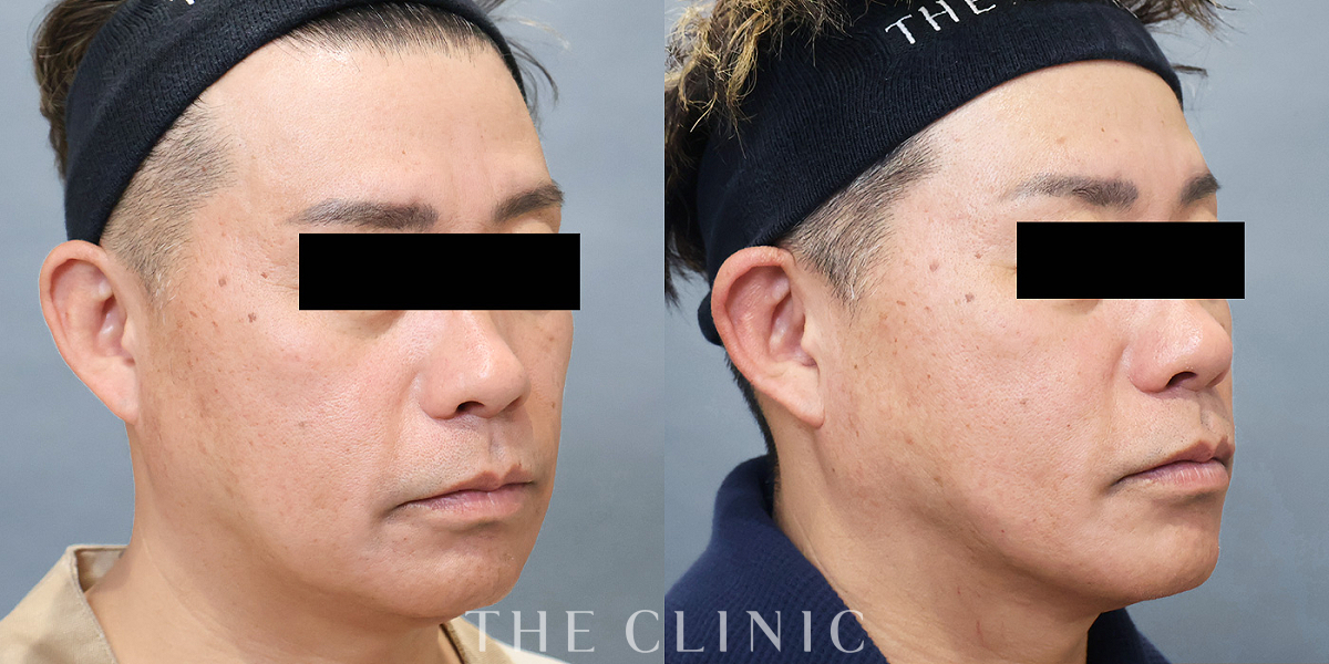 VOVリフト(ボブリフト・プレミアム)の術前／術後