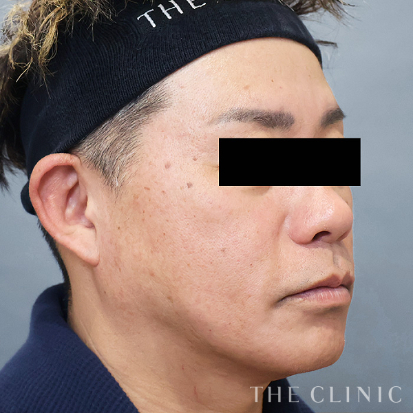 頰／顎のVOVリフト(ボブリフト・プレミアム)（49歳男性）の術後写真