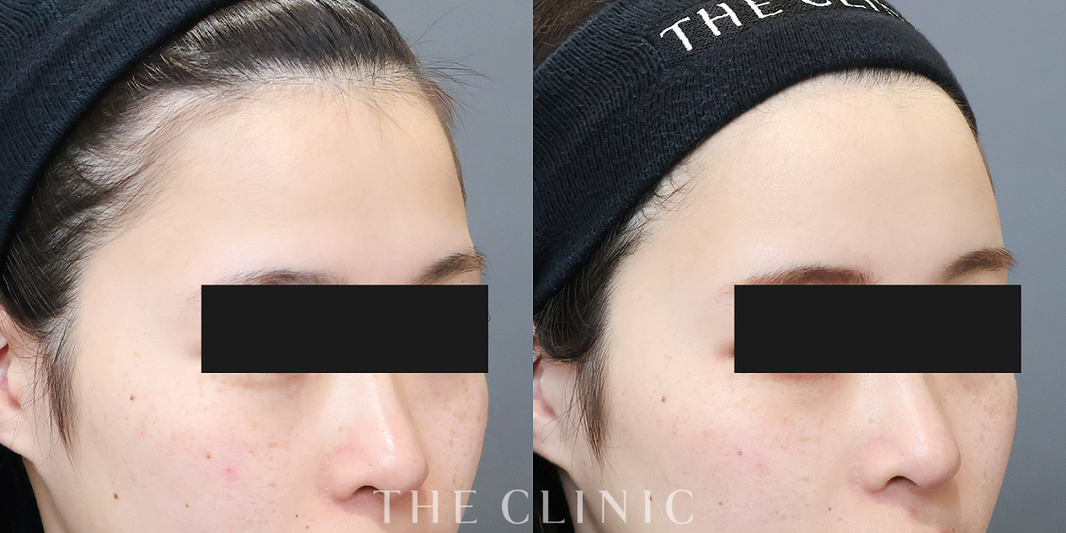 コンデンスリッチフェイス(顔の脂肪注入)の術前／術後