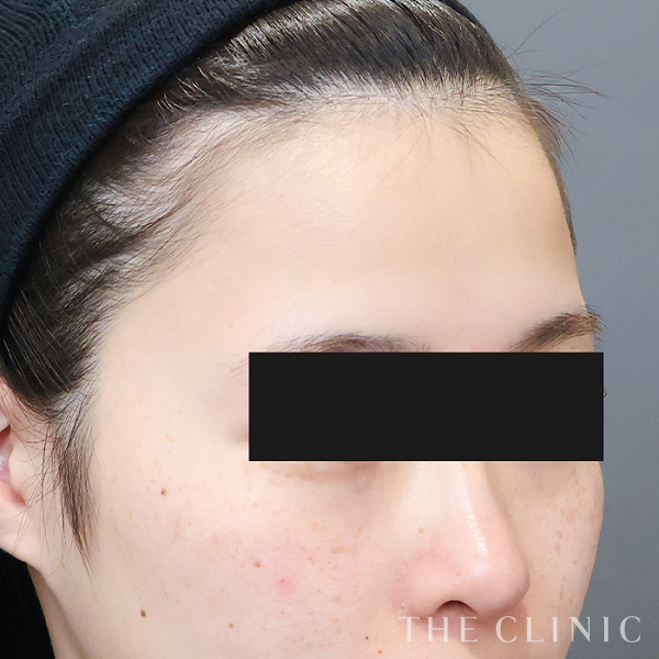 おでこ(額)のくぼみのコンデンスリッチフェイス(顔の脂肪注入)（23歳女性）の術前写真