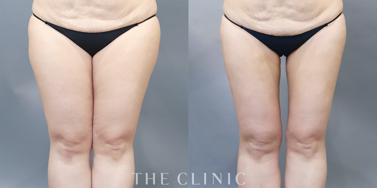 ベイザー脂肪吸引の術前／術後