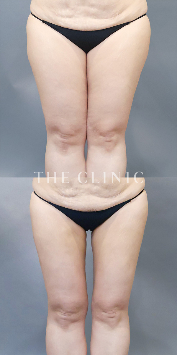 太もものベイザー脂肪吸引（48歳女性）の術前・術後写真