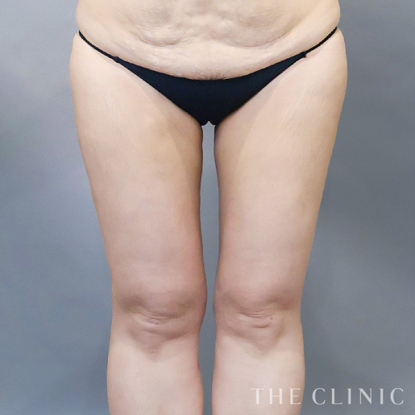 太もものベイザー脂肪吸引（48歳女性）の術後写真