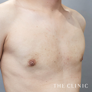 【THE CLINIC 症例画像】No.1609_2_真性＋偽性女性化乳房_女性化乳房治療(男性の胸の膨らみ改善)