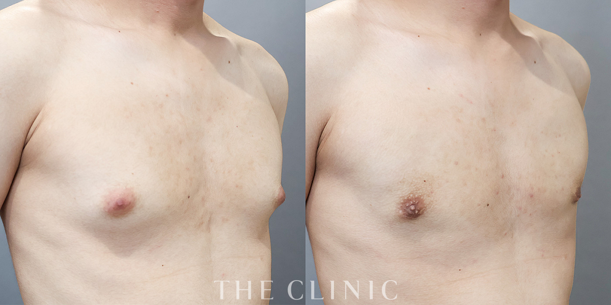 女性化乳房治療(男性の胸の膨らみ改善)の術前/術後